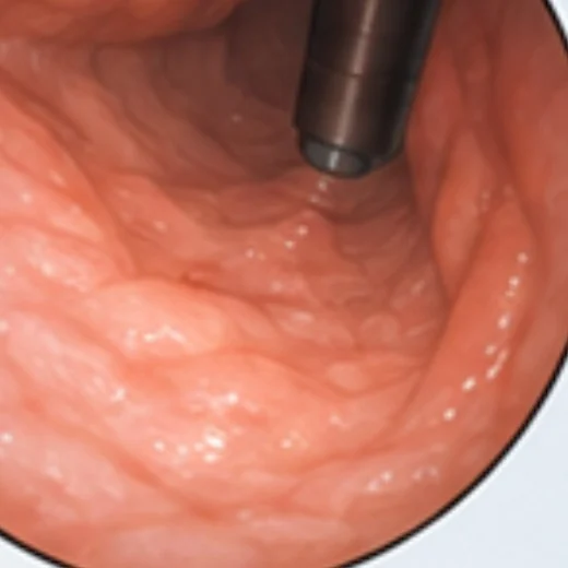 Visione endoscopica della mucosa gastrica